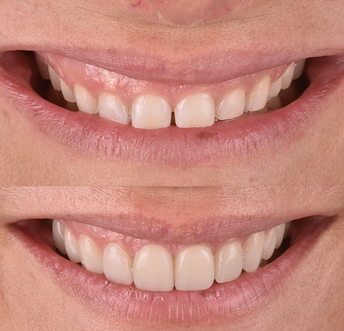 Carillas dentales de porcelana: consigue una sonrisa a tu medida mejorando de manera definitiva la estética de tu boca
