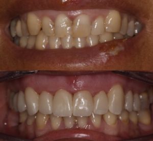 Antes y después carillas dentales dientes apiñados cambre