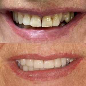 Antes y después carillas dentales dientes gastados