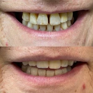Antes y después - implantes dentales