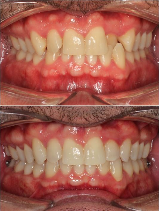 Antes y después ortodoncia invisible