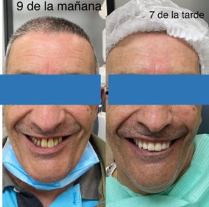 Implantes dentales - Antes y después