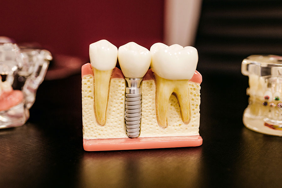Puentes dentales o implantes ejemplo
